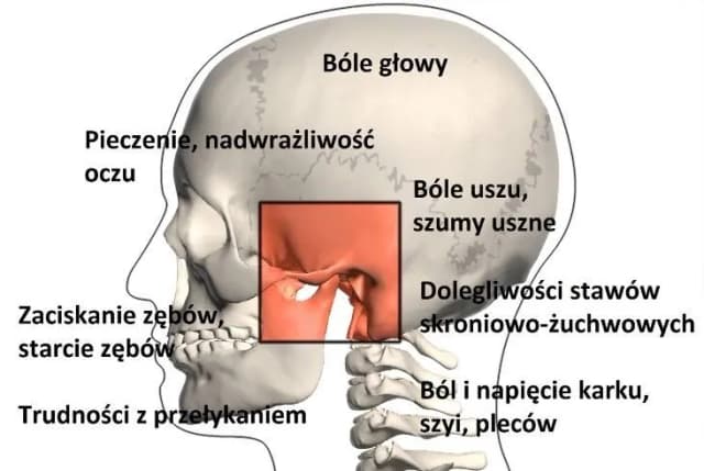 Ból stawu skroniowo-żuchwowego: do jakiego lekarza się udać? Ból stawu skroniowo-żuchwowego: do jakiego lekarza się udać?